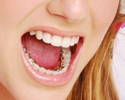 Lingual Braces