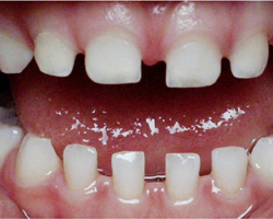 Teeth Spacing