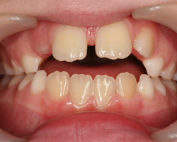 Thumbing of Teeth